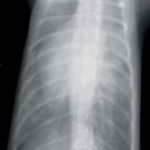radio thrombose chat